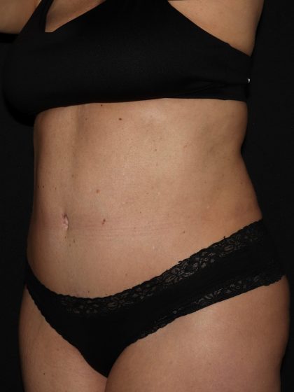 Tummy Tuck Before & After Patient #1892