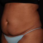 Tummy Tuck Before & After Patient #1892