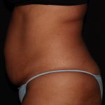 Tummy Tuck Before & After Patient #1892