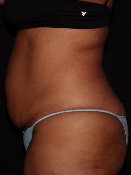 Tummy Tuck Before & After Patient #1892